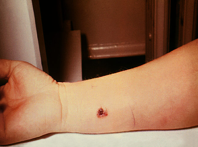 Anthrax, skin of right forearm, 7th day.