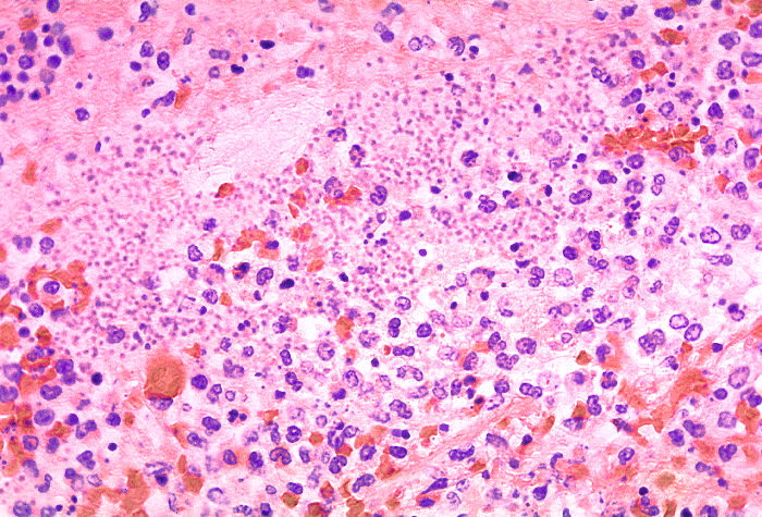 Histopathology of lung in a case of fatal human plague