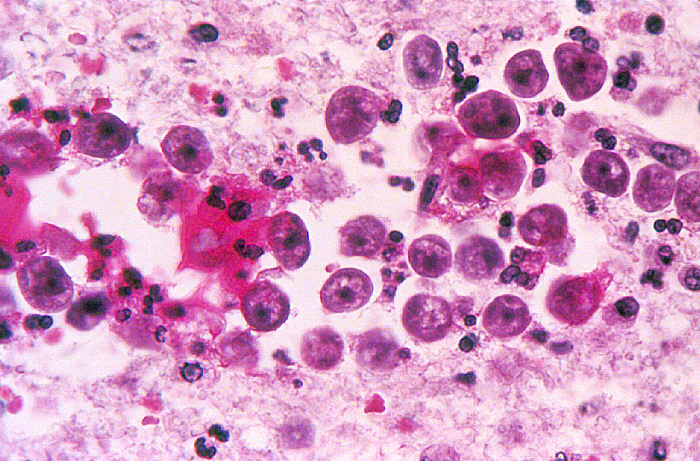 Magnified 500X, this photomicrograph depicted some of the histopathologic changes associated with an infection found in a brain tissue specimen due to the presence of free-living amoebae of the genus, Naegleria. Free-living amoebae belonging to the genera Acanthamoeba, Balamuthia, and Naegleria, are important causes of disease in humans and animals.