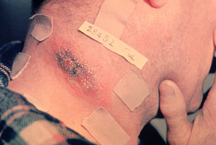 Anthrax lesion on the neck.