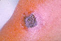 Anthrax, skin of left forearm.