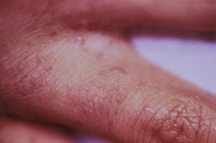 Scabies spreads rapidly under crowded conditions where there is frequent 