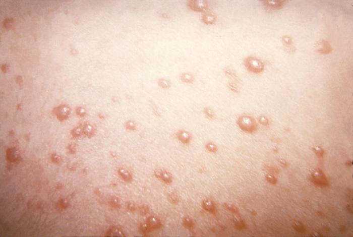 Herpes simplex virus, otherwise known as “Herpesvirus hominis” is a member