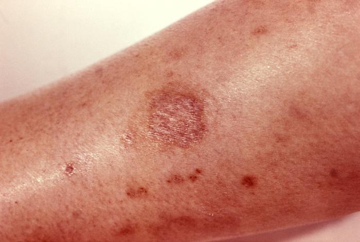 Serious Spider Bites Need Serious Wound Treatment - Covenant Health