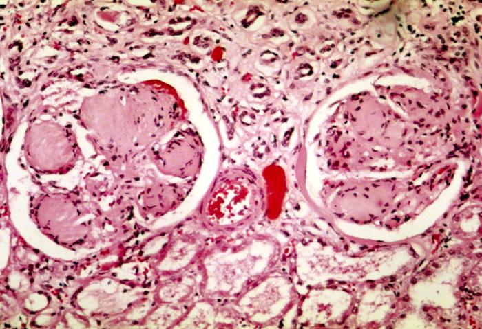 Histopathology of the kidney revealing nodular glomerulosclerosis