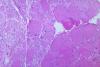 A photomicrograph of skeletal muscle tissue revealing myotonic dystrophic changes as a result of Polio Type III.