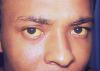 The viral disease Hepatitis A is manifested here as icterus, or jaundice of the conjunctivae and facial skin.