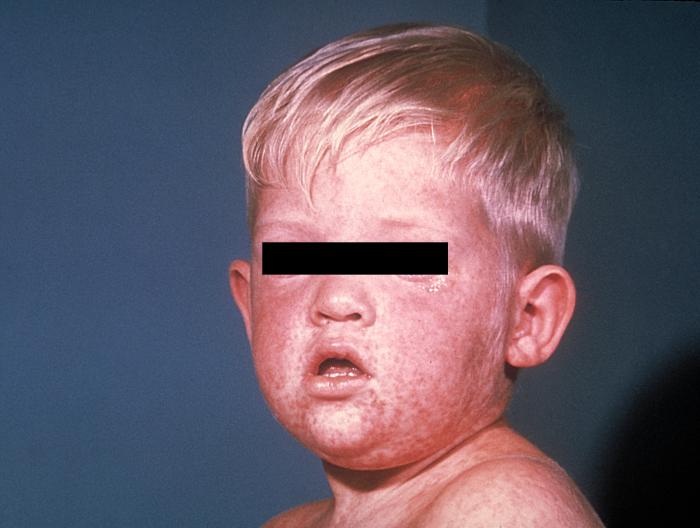 This photograph depicts the face of a young boy with measles, which was captured on the third day of its characteristic rash.