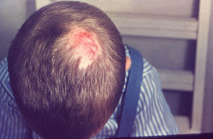 Tinea capitis infection on a boy's scalp - Stock Image - C058/6070 -  Science Photo Library