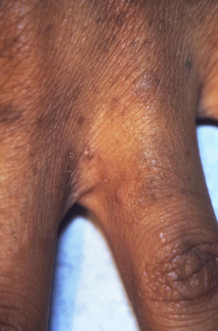 Scabies infection on the skin - Stock Image - C052/8172 - Science Photo  Library