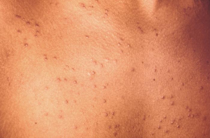 Heat Rash or Prickly Heat (Miliaria Rubra) Condition, Treatments and  Pictures for Infants - Skinsight