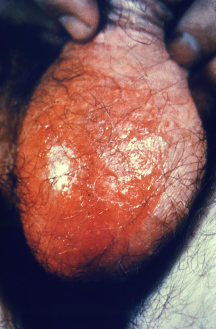 eczema on scrotum