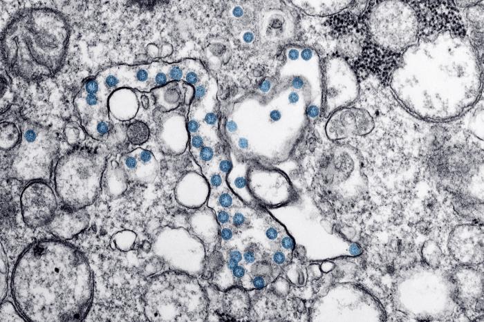 Transmission electron microscopic image of an isolate of COVID-19