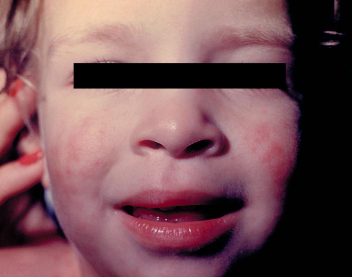 meningitis rash on face
