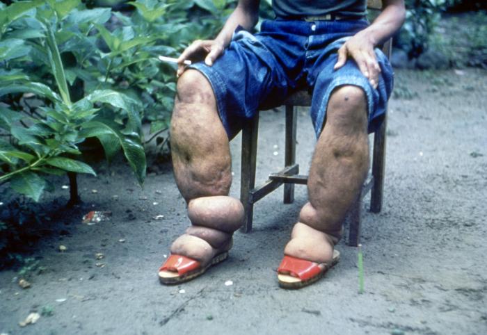 Image: Advanced Elephantiasis - a patient in the Philippines