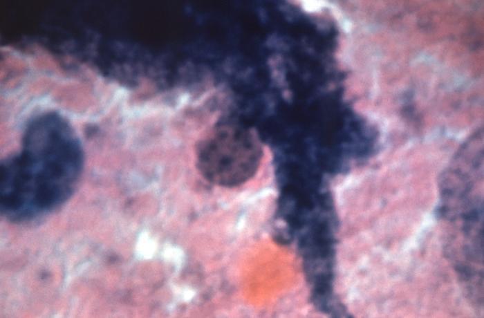 Pathognomonic signs: Negri bodies in the cytoplasm of neuronal cells