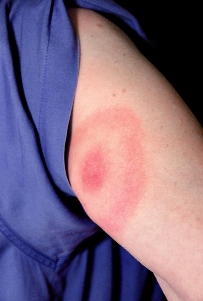 Pathognomonic Signs: Erythema migrans by tick bite