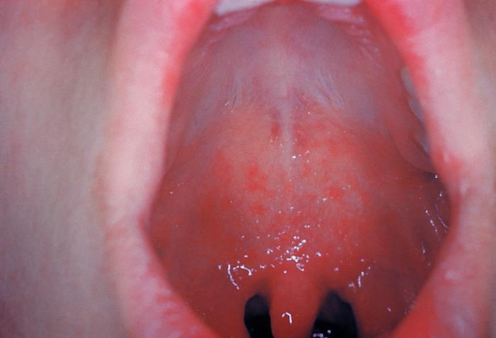 This image depicts an intraoral view of a patient, who had presented to a clinical setting exhibiting redness and edema of the oropharynx, and small red spots, on the soft palate mucosa. A diagnosis of Koplik’s spots on the soft palate and oropharynx was made, due to pre-eruptive measles, on day-3 of the illness.