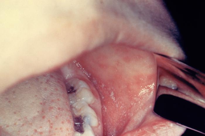 Pathognomonic signs: Koplik's spots are pathognomonic for measles