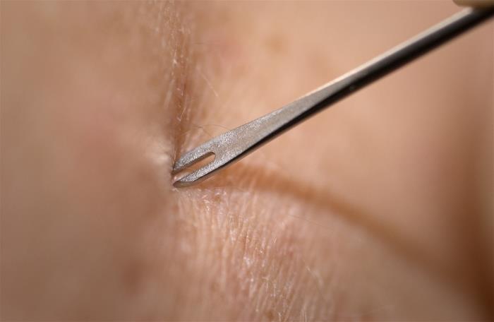 CDC Clinician demonstrates the use of a bifurcated needle during the 2002 Smallpox Vaccinator Workshop