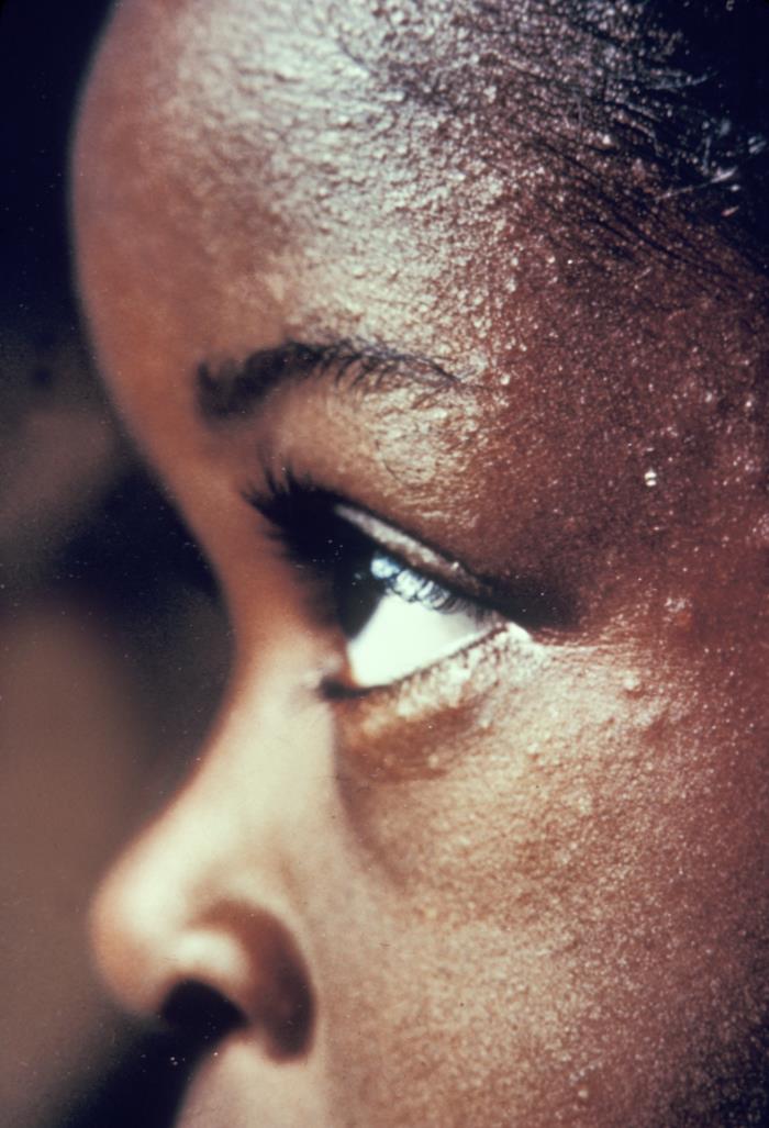 After undergoing smallpox vaccination, this child has very minimal, scattered vaccinial lesions about the eyes and forehead