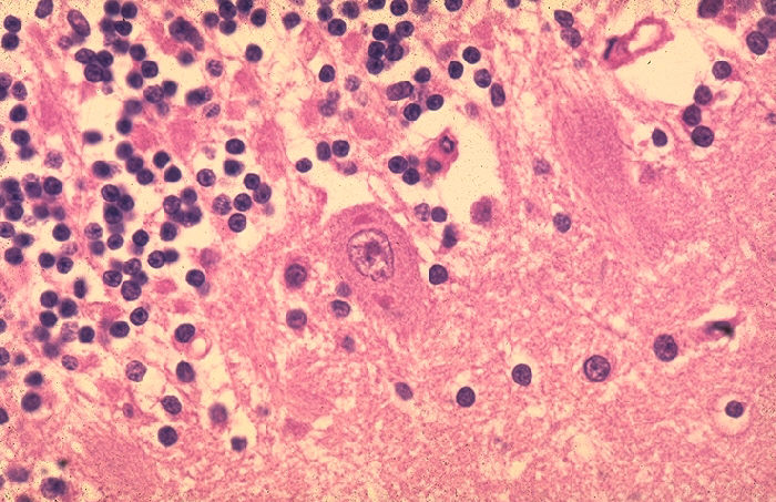 Histopathology of rabies, brain.