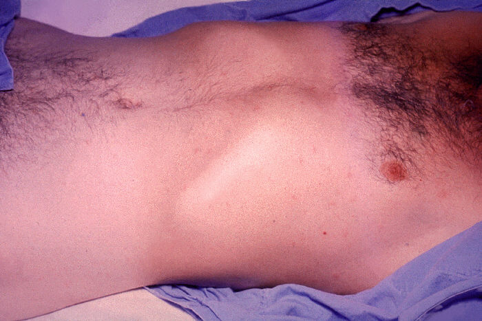Rose spots on abdomen of a patient with typhoid fever due to the bacterium <em>Salmonella</em> Typhi.