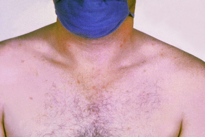 Rose spots on the chest of a patient with typhoid fever due to the bacterium <em>Salmonella</em> Typhi.