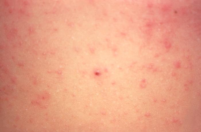 what-are-the-signs-and-symptoms-of-chicken-pox-2013s2-34b-chicken-pox