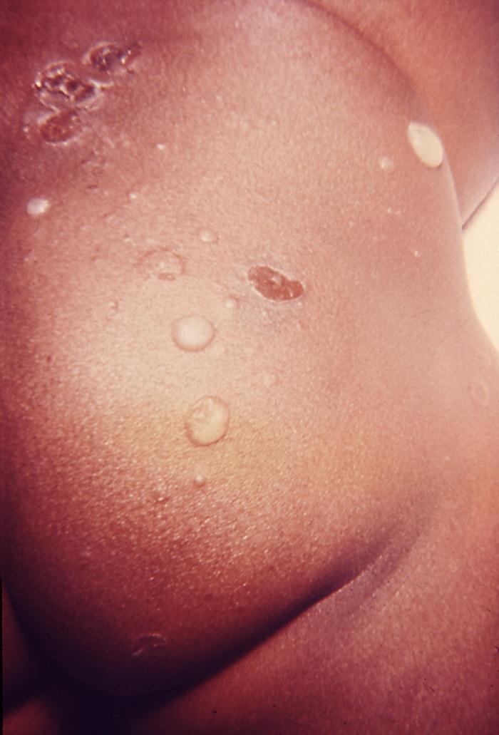 Staphylococcal Scalded Skin Syndrome (SSSS) in Children ...