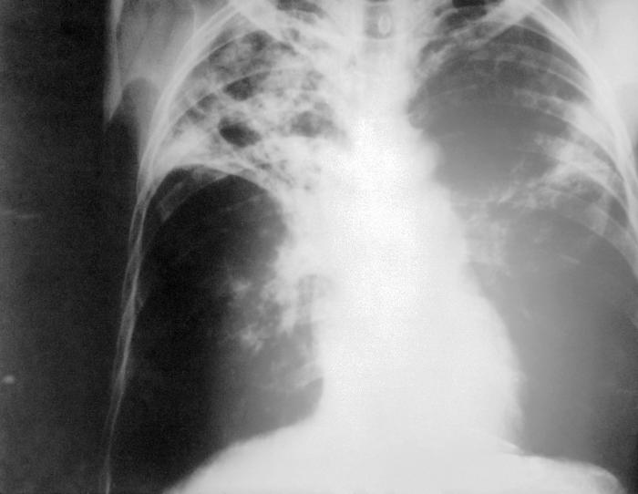 An anteroposterior X-ray of a patient diagnosed with advanced bilateral pulmonary tuberculosis.