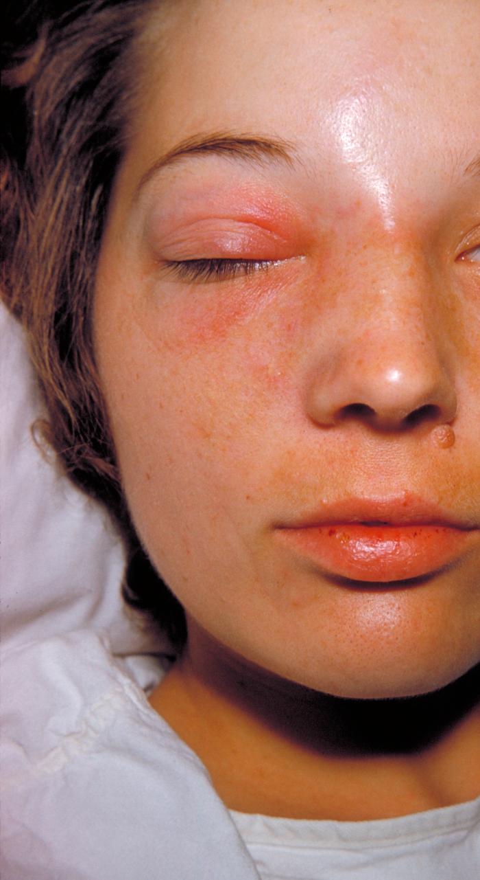 Eyelid rash - RightDiagnosis.com