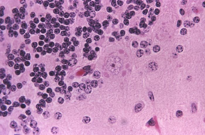 This photomicrograph demonstrates cellular changes associated with rabies encephalitis using an H&E staining technique.