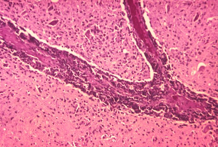 This micrograph depicts the histopathologic changes associated with rabies encephalitis prepared using an H&E stain.