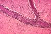 This micrograph depicts the histopathologic changes associated with rabies encephalitis prepared using an H&E stain.