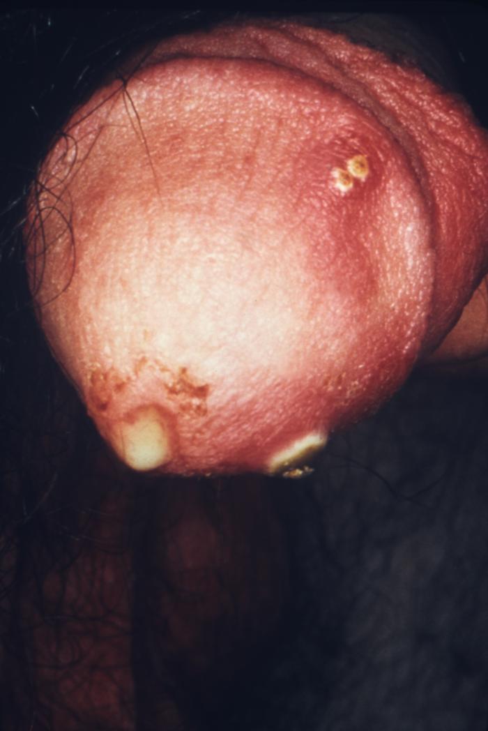 Details - Public Health Image Library(PHIL)