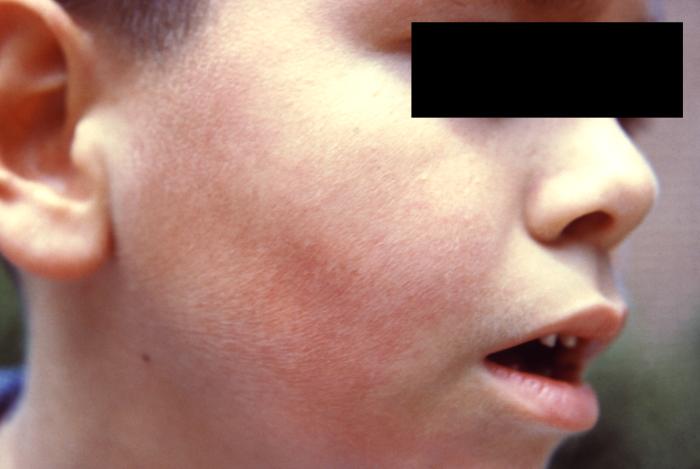 What Causes a Petechial Rash in a Child - information and ...